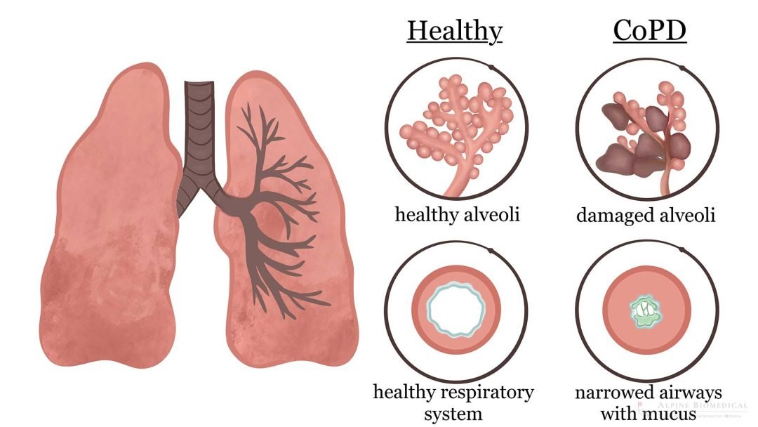 can COPD be cured