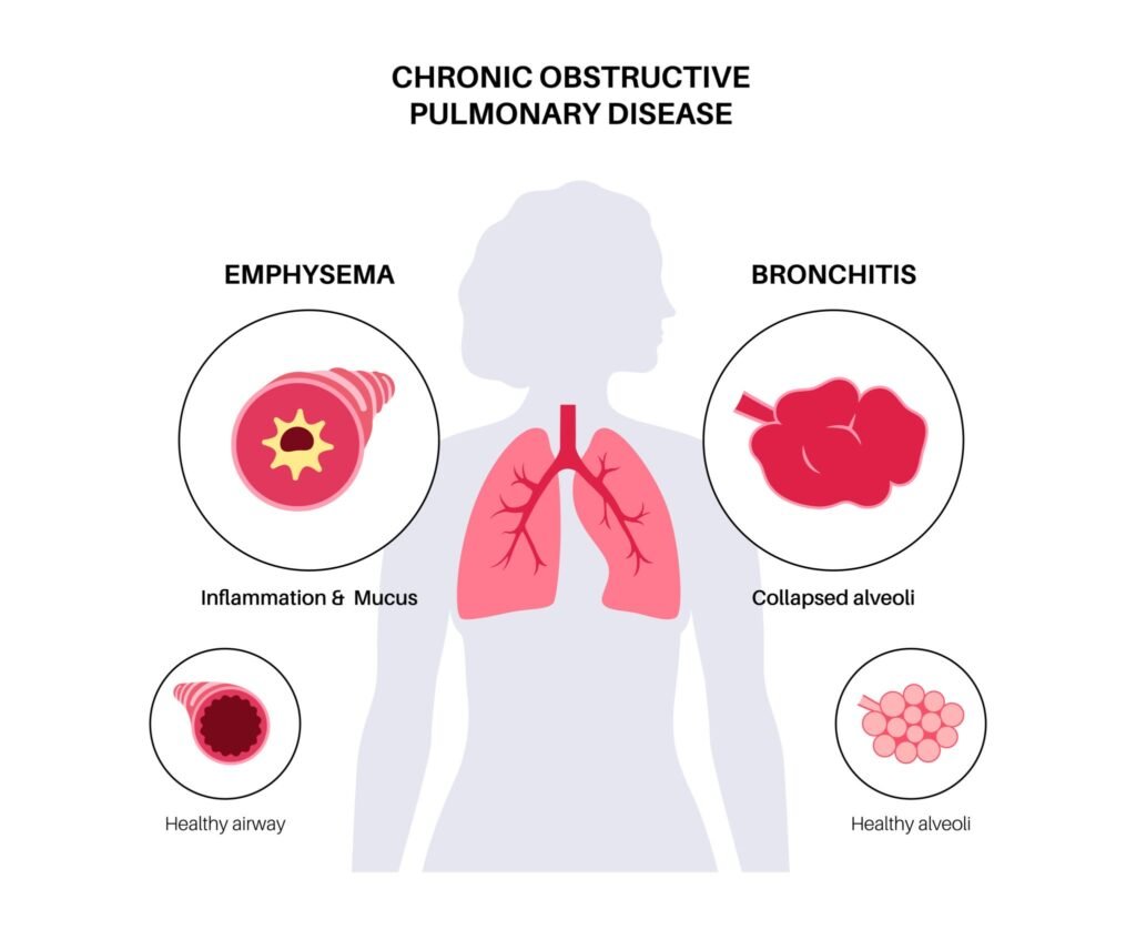 The Two Main Components of COPD